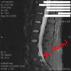 jm-spine-herniated-disc
